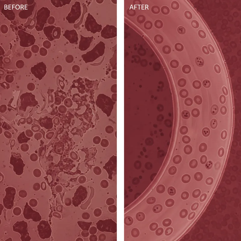 Micrografía fluorescente de microcoágulos amiloides en sangre de pacientes post-COVID mostrando agregados de fibrina resistentes